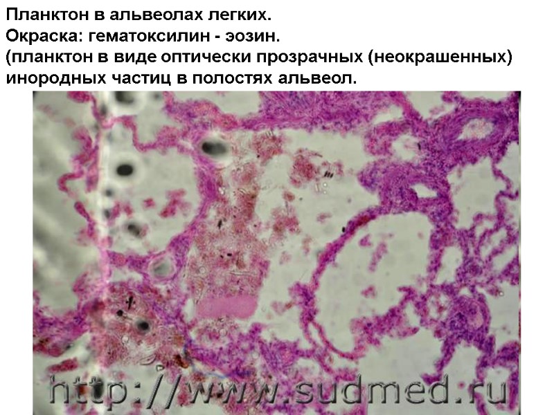 Планктон в альвеолах легких. Окраска: гематоксилин - эозин. (планктон в виде оптически прозрачных (неокрашенных)